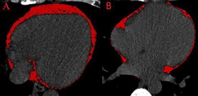 The relationship between frequent premature ventricular complexes and epicardial adipose tissue volume